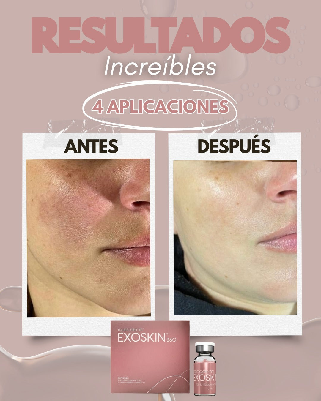 EXOSKIN 360 1 Caja